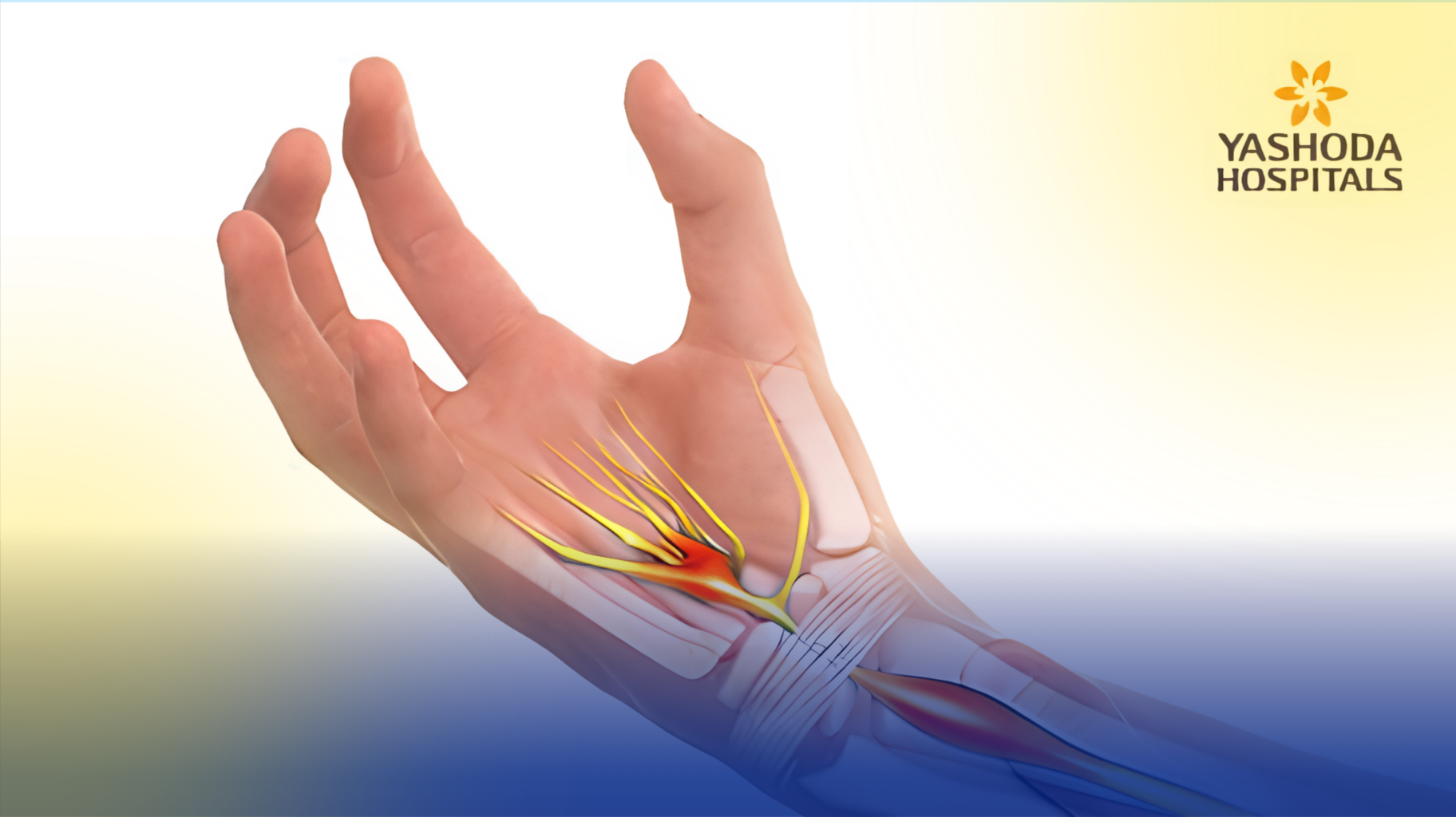 CARPAL TUNNEL SYNDROME, PANANAKIT AT PAMAMANHID NG KAMAY HUWAG IPAGWALANG-BAHALA, ALAMIN